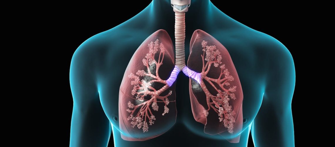 Kanker Paru-paru: 7 Gejala yang Perlu Diwaspadai